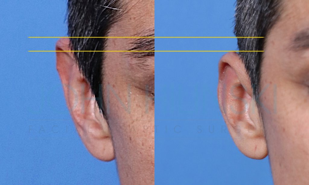 Side-by-side comparison of a person's ear before and after a surgical procedure, highlighting reshaping of the ear with a blue background.