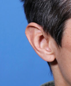 Oblique view of male patient's ear before macrotia reduction surgery  