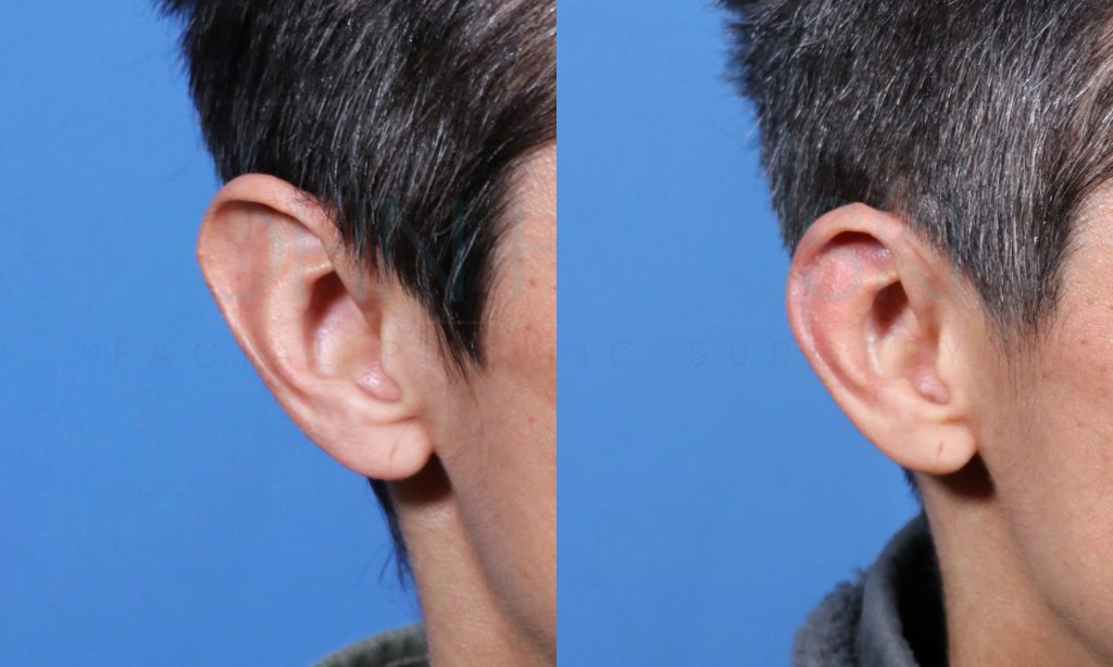 Before and after images of an ear surgery, showing changes in ear shape and positioning.